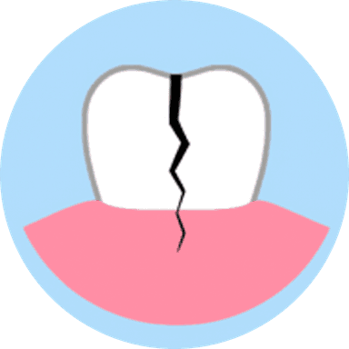 Vertical Root Fracture