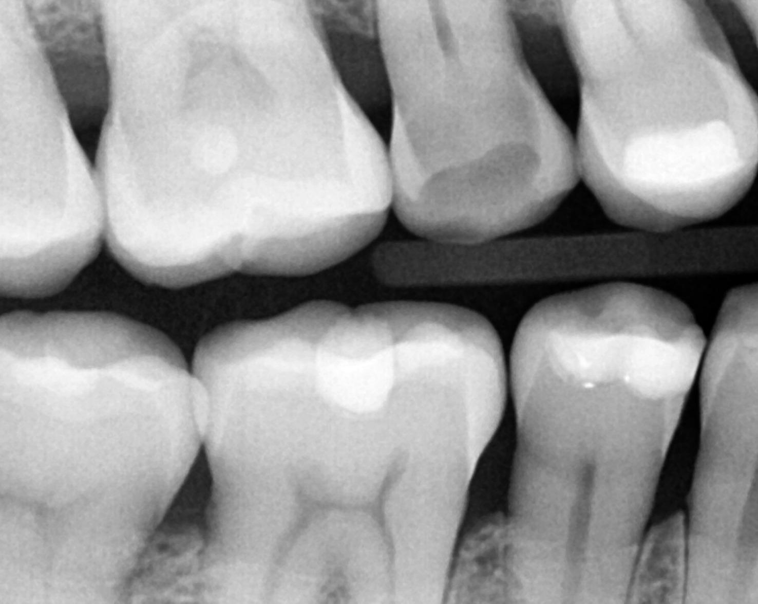 BiteWing of Tooth #4