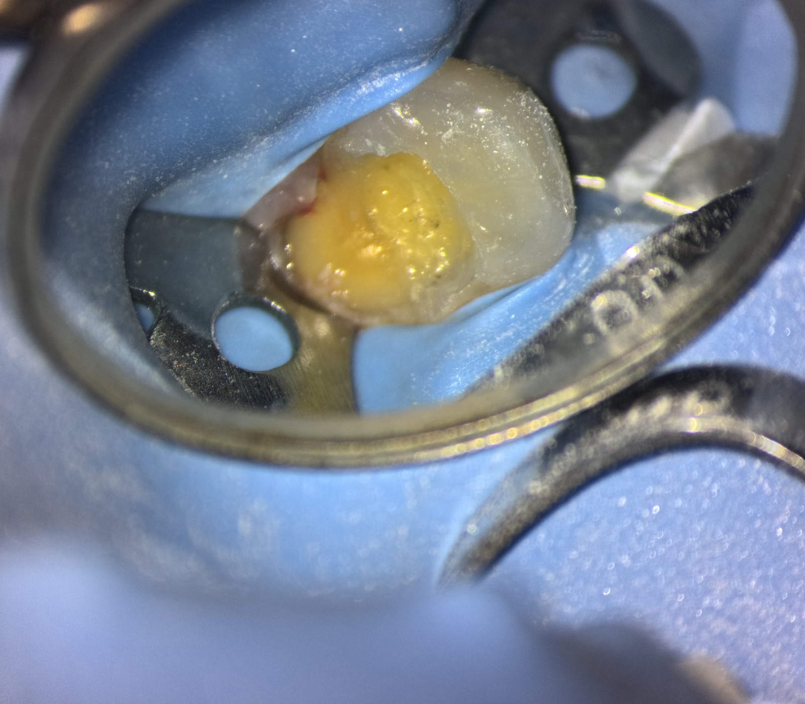 Patient Presentation of Tooth 4