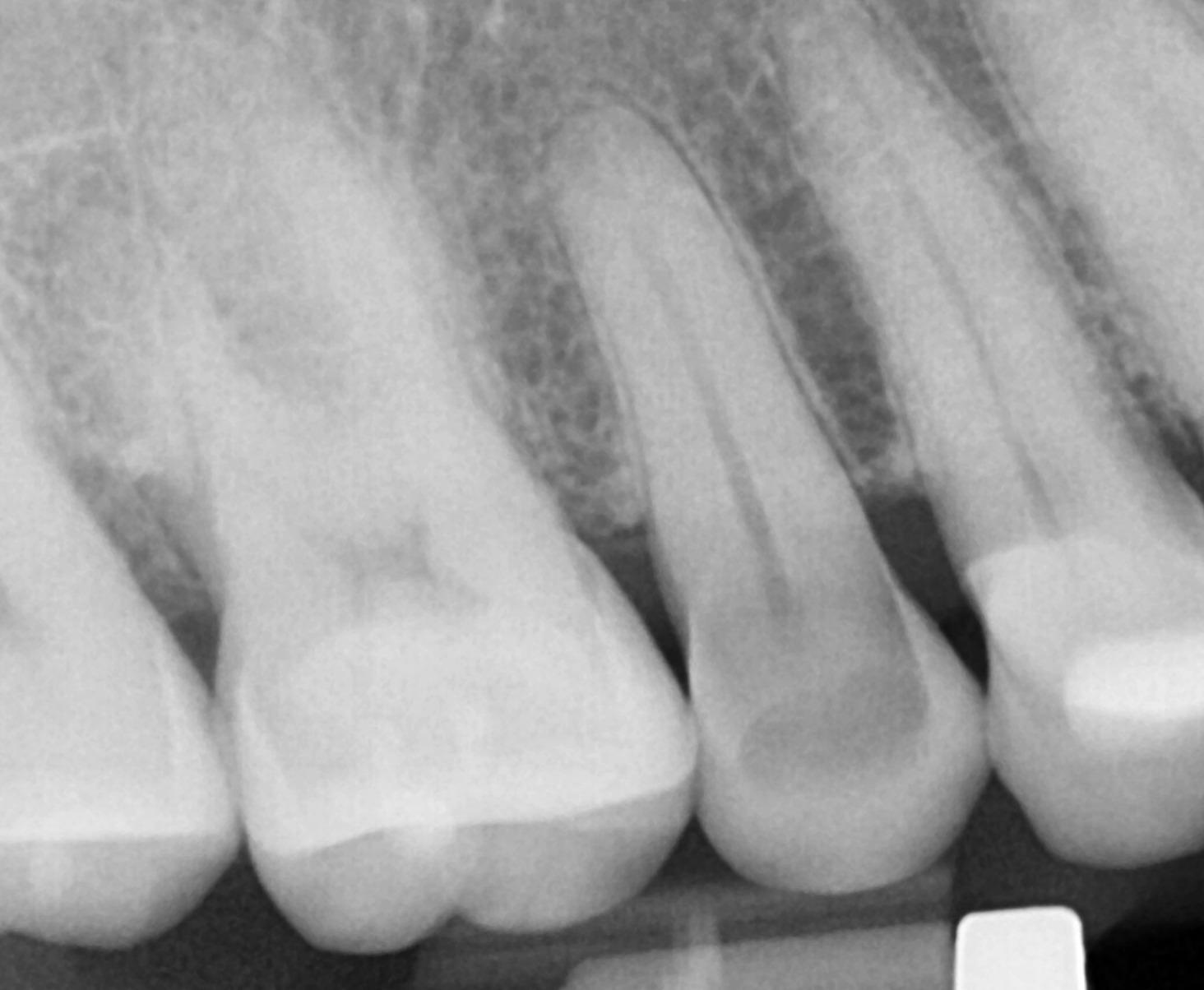 Radiograph of Tooth #4